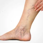 Роль флеболога в лечении варикоза и тромбофлебита