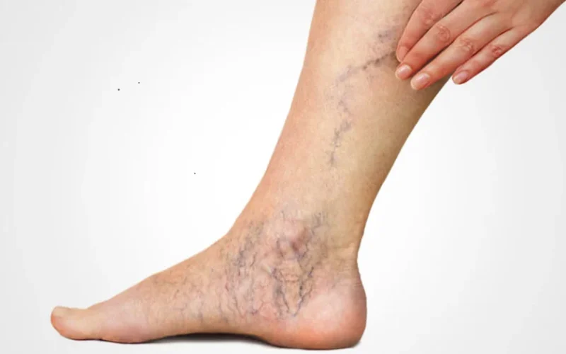 Роль флеболога в лечении варикоза и тромбофлебита